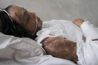 Nữ sinh có nguy cơ mù 2 mắt vì bị tạt axit 