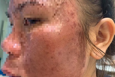 Cô gái trẻ “cháy” mặt vì bôi dưỡng chất trị nám và trứng cá