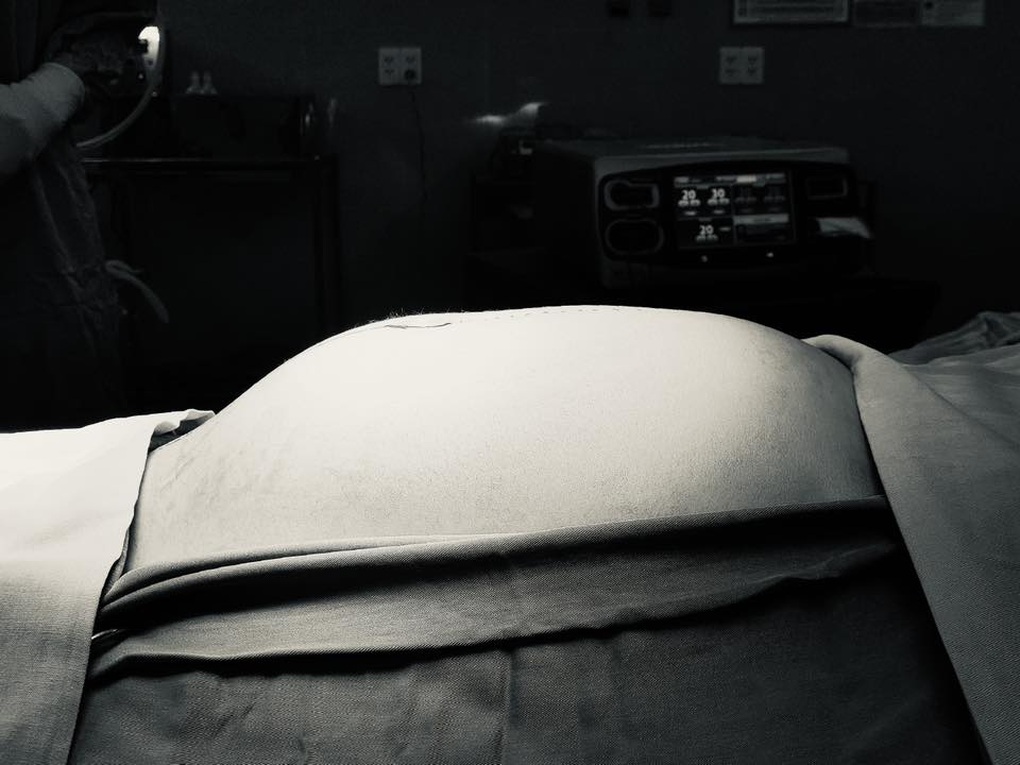 ورم يزن حتى 8 كجم في مبيض فتاة تبلغ من العمر 13 عامًا - 1 Khối u nặng tới 8kg trong buồng trứng bé gái 13 tuổi - 1