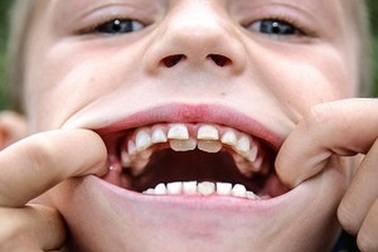 Cậu bé sở hữu “hàm răng cá mập”