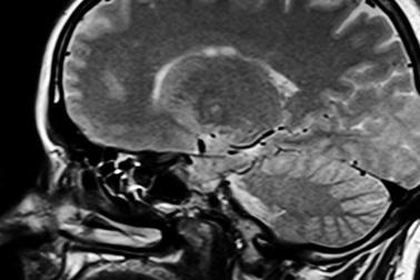 "Điều chỉnh" bộ não để làm giảm đau