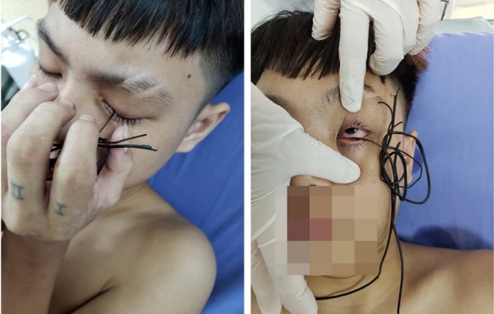 Hoảng hồn lõi kim loại dây điện cắm vào mắt nam thanh niên 16 tuổi - 1 Hoảng hồn lõi kim loại dây điện cắm vào mắt nam thanh niên 16 tuổi - 1