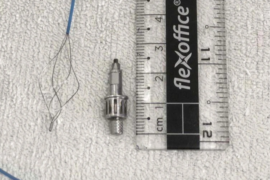 Mất dụng cụ khi làm răng, 2 tuần sau mới phát hiện trong phế quản bệnh nhân - 1 Mất dụng cụ khi làm răng, 2 tuần sau mới phát hiện trong phế quản bệnh nhân - 1