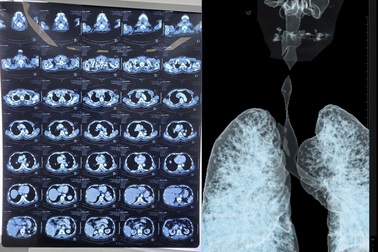 Cứu người đàn ông bị khối u hiếm gặp chặn đường thở nguy kịch