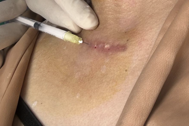 Cô gái bị thẩm mỹ viện tạo "con rết" ở cổ: Tiết lộ sự thật khi đi trị sẹo