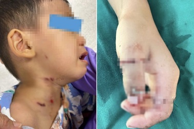 Nhiều trẻ lâm nguy vì đủ loại hiểm họa: Chó cắn vào cổ, liềm cắt đứt tay
