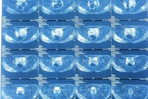 Những “viên ngọc" trong suốt khiến bác sĩ ám ảnh khi xử lý tai biến nâng ngực silicon lỏng cho phái đẹp