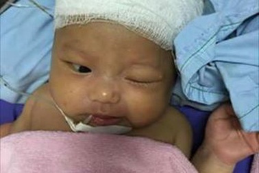 Ghép sọ cứu bé trai 37 ngày tuổi bị chảy máu não vì thiếu vitamin K