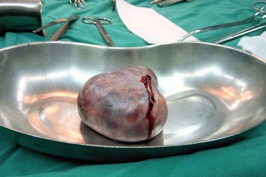 Hi hữu cứu sống nữ sinh mắc bệnh hiếm sau 5 tháng nằm viện