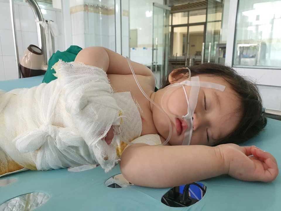 Đau nhói lòng cảnh bé gái 14 tháng tuổi ngã vào nồi nước sôi nguy kịch - 2 Đau nhói lòng cảnh bé gái 14 tháng tuổi ngã vào nồi nước sôi nguy kịch - 2