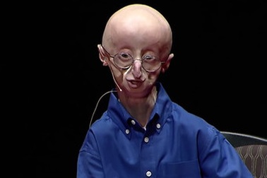 Nghị lực phi thường của cậu bé tuổi teen mắc chứng lão hóa sớm