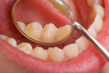 Dấu hiệu của ung thư miệng là gì?