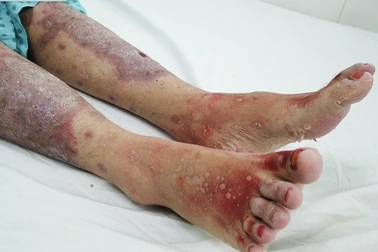 Cô gái bong tróc da toàn thân, nguy kịch sau khi uống thực phẩm chức năng