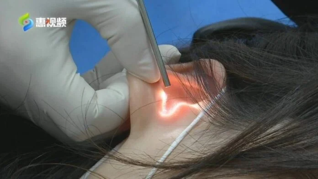 Sau nụ hôn quá đà của bạn trai, cô gái Trung Quốc bị thủng màng nhĩ - 2 Sau nụ hôn quá đà của bạn trai, cô gái Trung Quốc bị thủng màng nhĩ - 2