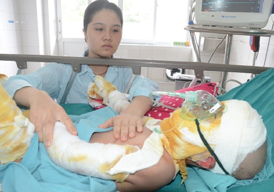 Cậu bé như “ngọn đuốc” trong vụ hoả hoạn tiếp tục được bạn đọc Dân trí giúp đỡ - 1 Cậu bé như “ngọn đuốc” trong vụ hoả hoạn tiếp tục được bạn đọc Dân trí giúp đỡ - 1