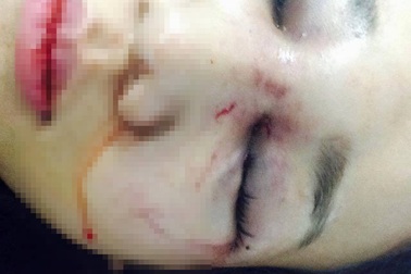 Thiếu úy công an bị tố đánh bạn gái chấn thương sọ não