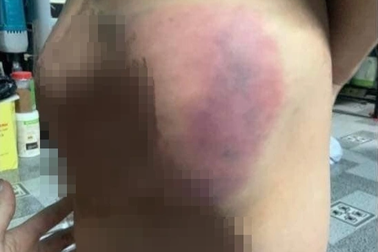 Bé trai bị người dạy trẻ đánh bầm tím ở lớp học hè không phép