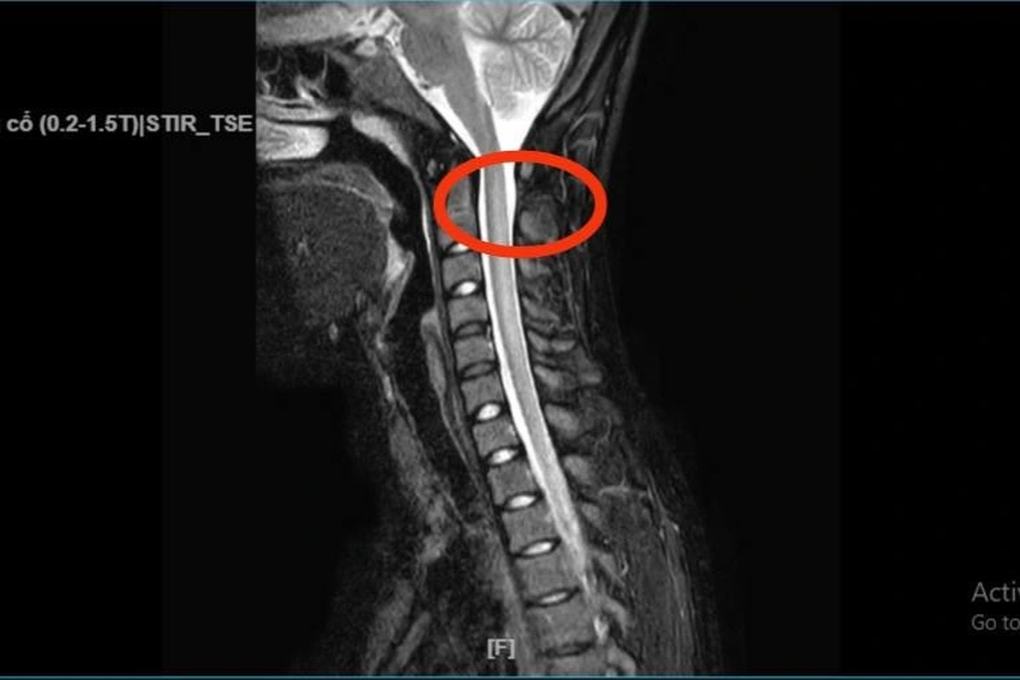 Cô gái 19 tuổi bị tổn thương thần kinh cổ vì hít bóng cười suốt 4 tháng - 2 Cô gái 19 tuổi bị tổn thương thần kinh cổ vì hít bóng cười suốt 4 tháng - 2