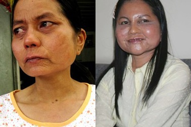 “Cô gái hóa bà lão” bất ngờ trẻ lại nhờ cấy mỡ dưới da 