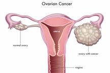 Ung thư buồng trứng giai đoạn 3 điều trị như thế nào?