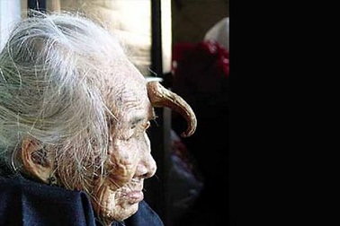 Gặp những người mọc sừng trên đầu