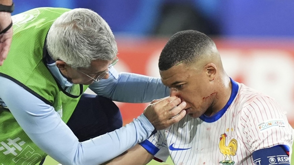 Mbappe phải đeo mặt nạ thi đấu cho đội tuyển Pháp ở Euro 2024 - 1 Mbappe phải đeo mặt nạ thi đấu cho đội tuyển Pháp ở Euro 2024 - 1