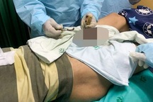 Người đàn ông có "của quý" bị biến dạng vĩnh viễn do mắc kẹt trong ổ khóa