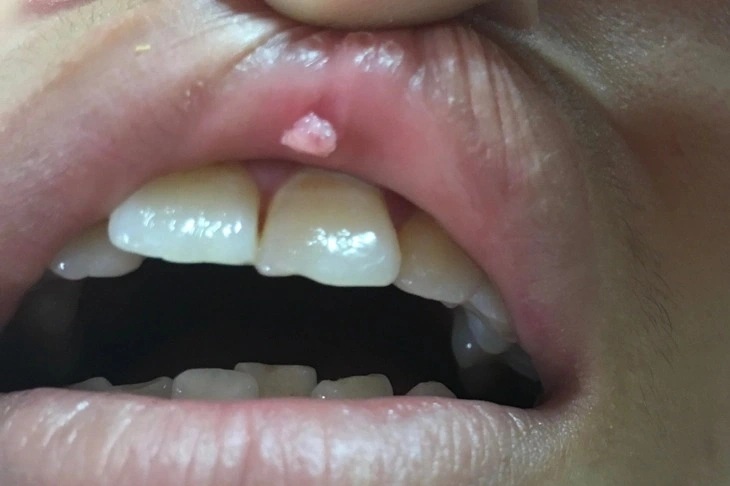 Cô gái mọc sùi mào gà ở miệng - 1