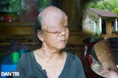 Sóng gió cuộc đời người đàn bà mang khuôn mặt "quỷ"