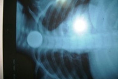 Cứu sống cháu bé 3 tuổi nuốt đồng tiền xu