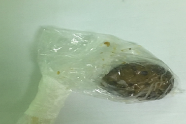 Đau bụng dữ dội vì nguyên cây nấm đông cô trong ruột