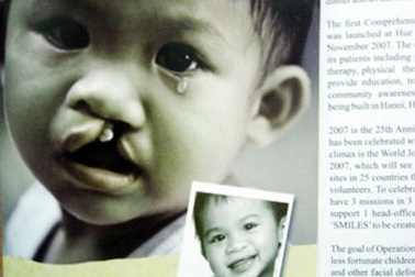 Phẫu thuật miễn phí cho trẻ sứt môi, hở hàm ếch