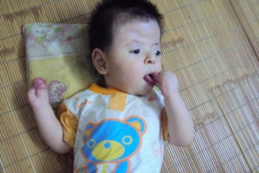 Bé trai bị Hội chứng Apert hiếm gặp được tài trợ phẫu thuật nước ngoài