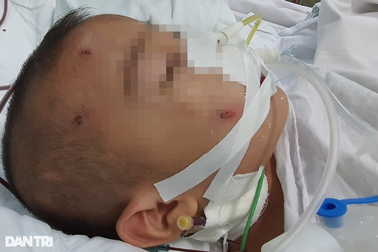 Bé trai 5 tuổi thủng ruột, dập gan, người có nhiều vết bầm bất thường