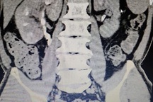Đau mỏi lưng kèm biểu hiện này coi chừng ung thư thận