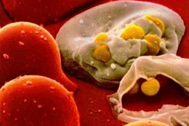 Virus HIV có thể trốn trong tủy xương