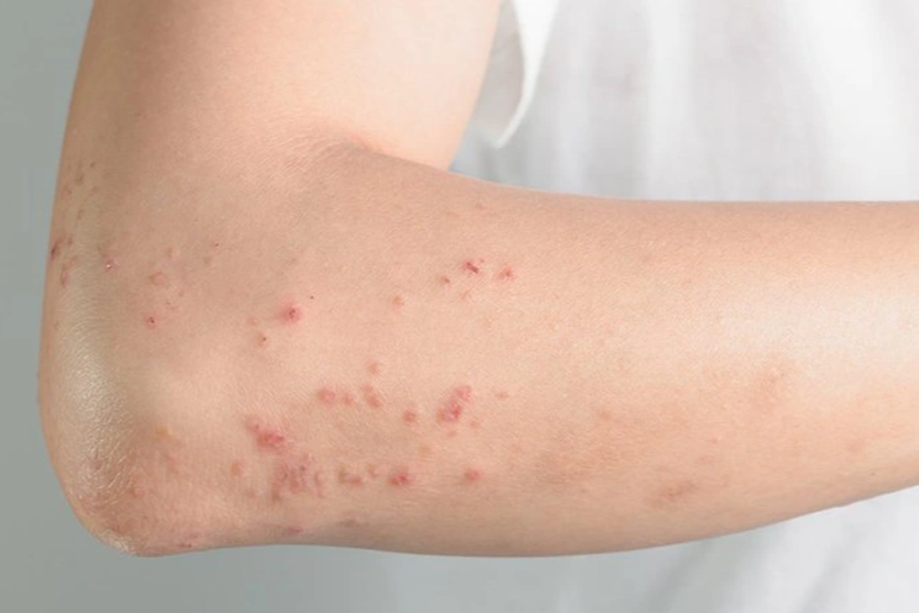 Bệnh tự miễn có làm tăng nguy cơ ung thư? - 2 Bệnh tự miễn có làm tăng nguy cơ ung thư? - 2