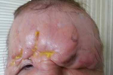 Biến chứng khủng khiếp sau tiêm chất làm đầy, xóa nhăn da