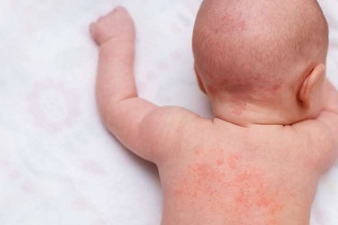 6 bước nhận biết và điều trị rôm sảy