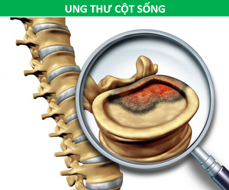 Đau vùng lưng dưới có thể là tín hiệu cảnh báo loại ung thư nào? - 2 Đau vùng lưng dưới có thể là tín hiệu cảnh báo loại ung thư nào? - 2