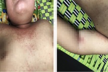 Bé trai nguy kịch vì căn bệnh xảy ra ngay sau khi vừa hết Covid-19