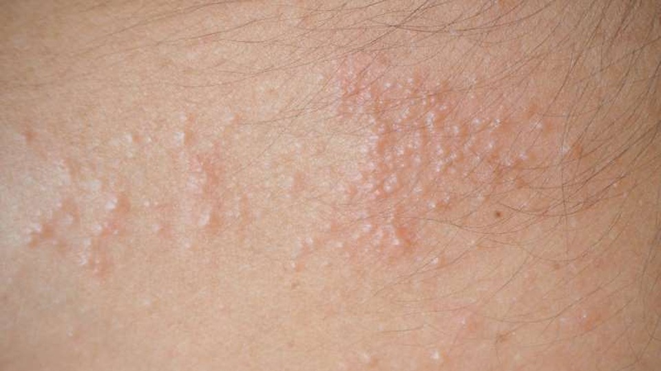 6 bước nhận biết và điều trị rôm sảy - 2 6 bước nhận biết và điều trị rôm sảy - 2