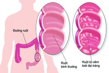 Lợi ích của bào tử lợi khuẩn trong việc hỗ trợ điều trị viêm đại tràng