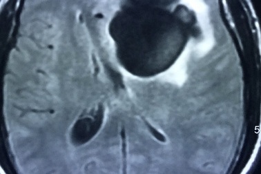 Thanh niên nghiện tiết canh bị hôn mê vì sán "ăn" não