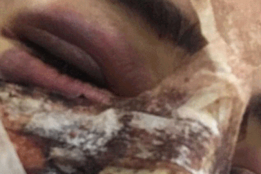 Người đẹp Anh chia sẻ ảnh sốc sau thẩm mỹ