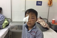 Bé 8 tuổi bị chó cắn rách giác mạc