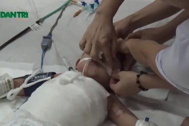 Bé 2 tuổi nguy kịch vì nồi canh đang sôi đổ ập vào người