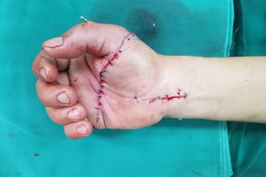 Vừa đi làm hậu Covid-19, người đàn ông TPHCM bị cưa máy chém gần lìa tay