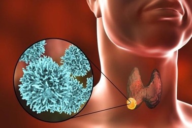 Nguy cơ tái phát bệnh ung thư tuyến giáp nếu người bệnh bỏ theo dõi định kỳ