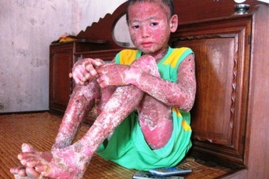 Thương cháu bé 14 tuổi bị vảy nến bao phủ toàn thân